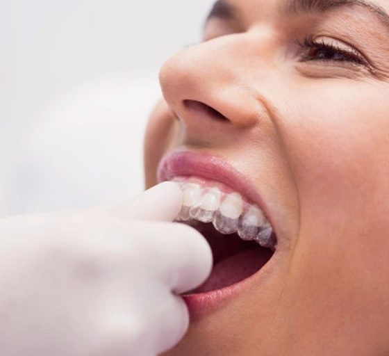 Clínica Dental Zoco Rivas. Los retenedores son parte importante de cualquier tratamiento de ortodoncia. Te explicamos como cuidar los retenedores dentales