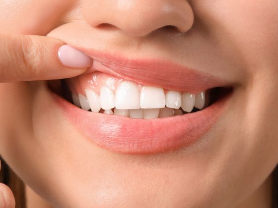 La periodontitis, es una enfermedad que afecta al tejido de las encías, si no se trata a tiempo puede ser peligrosa.